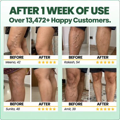 Herbal Miracle Balm for Varicose Veins Relief